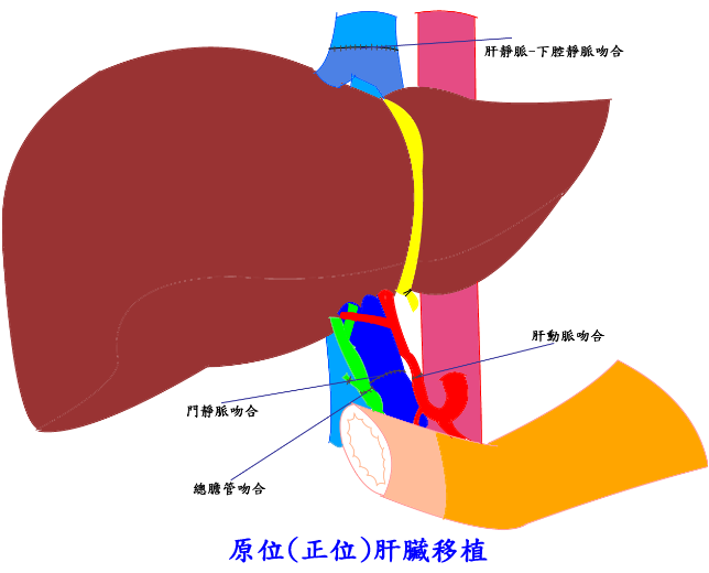 orthotopic liver transplantation
